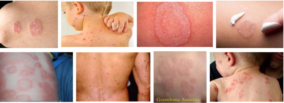 Các bệnh ngoài da do sử dụng nước bẩn nước ô nhiễm